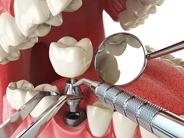 Best Emergency Dental Care for Broken or Chipped Teeth in Linden, TN